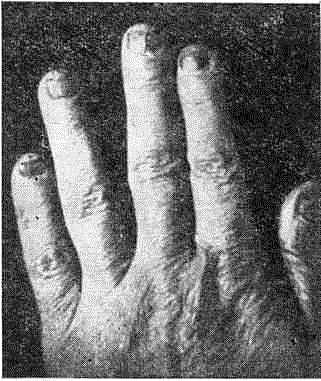 Трихофития ногтей