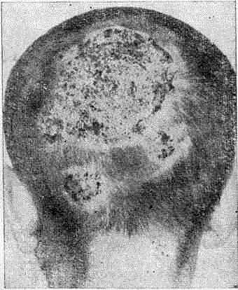 Глубокая нагноительная три­хофития волосистой части головы (kerion Celsi)