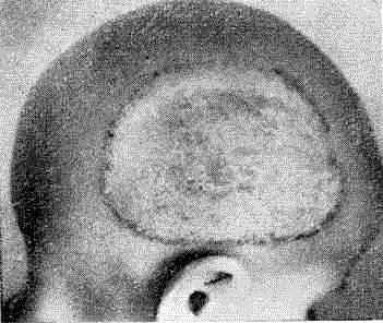 Микроспория волосистой части головы (ржавая»)