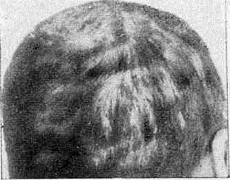 Фавус волосистой части го­ловы