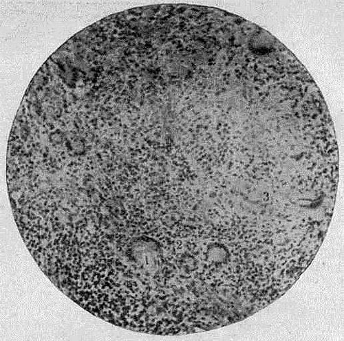 Патогистологические изменения у больных тубер­кулезной волчанкой. 1 — гигантские клетки Лангганса; 2 — микобактерии туберкулеза; 3 — казеозный некроз