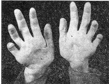 Недифферен­цированный тип леп­ры. Атрофия мышц кистей и контрактура пальцев