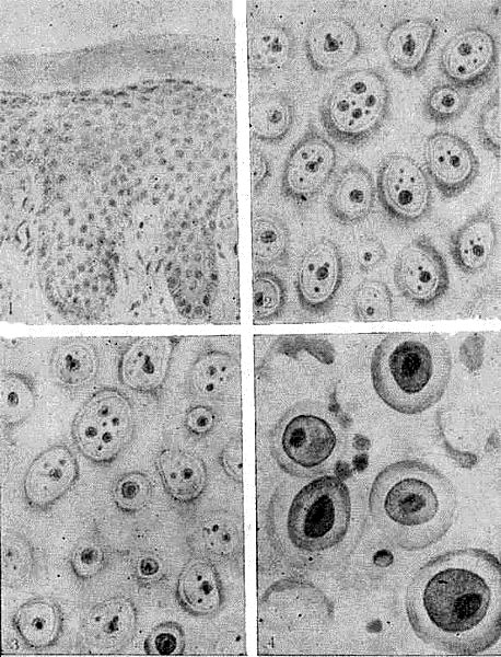 Акантолизис и акантолитические клетки